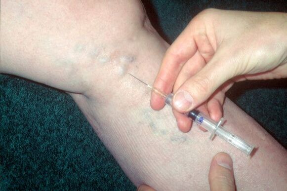 Scleroterapia pentru vene varicoase