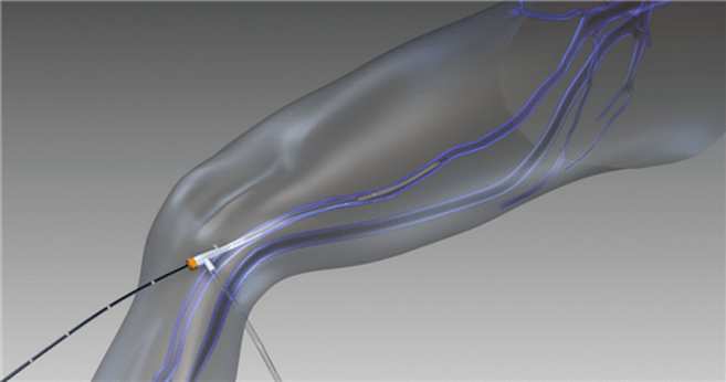 Obliterarea prin radiofrecvență pentru vene varicoase