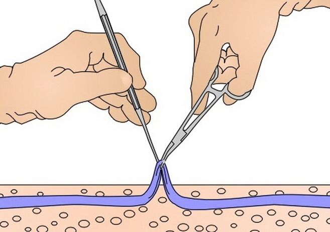 Striping vene pentru vene varicoase